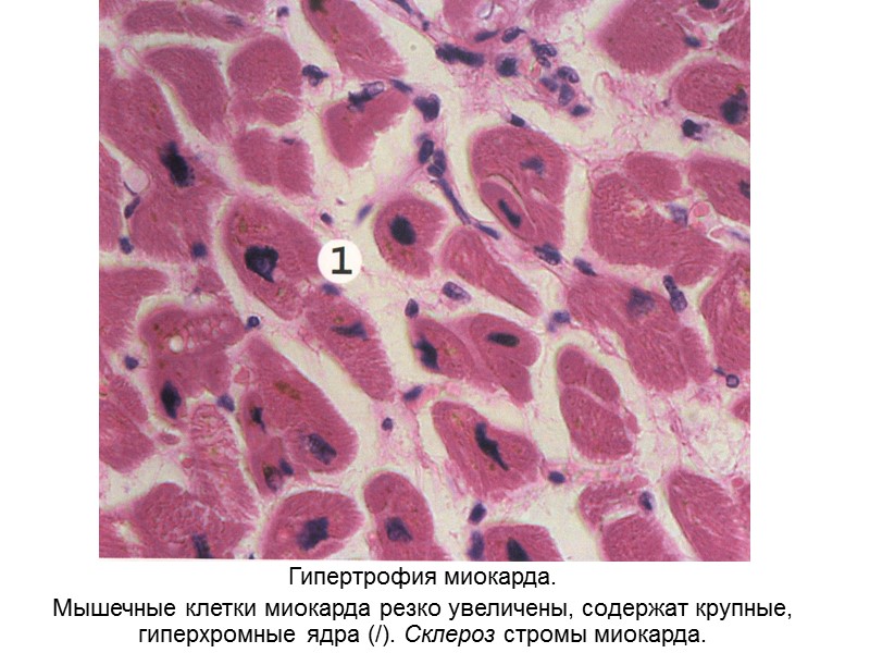 Гипертрофия миокарда. Мышечные клетки миокарда резко увеличены, содержат крупные, гиперхромные ядра (/). Склероз стромы